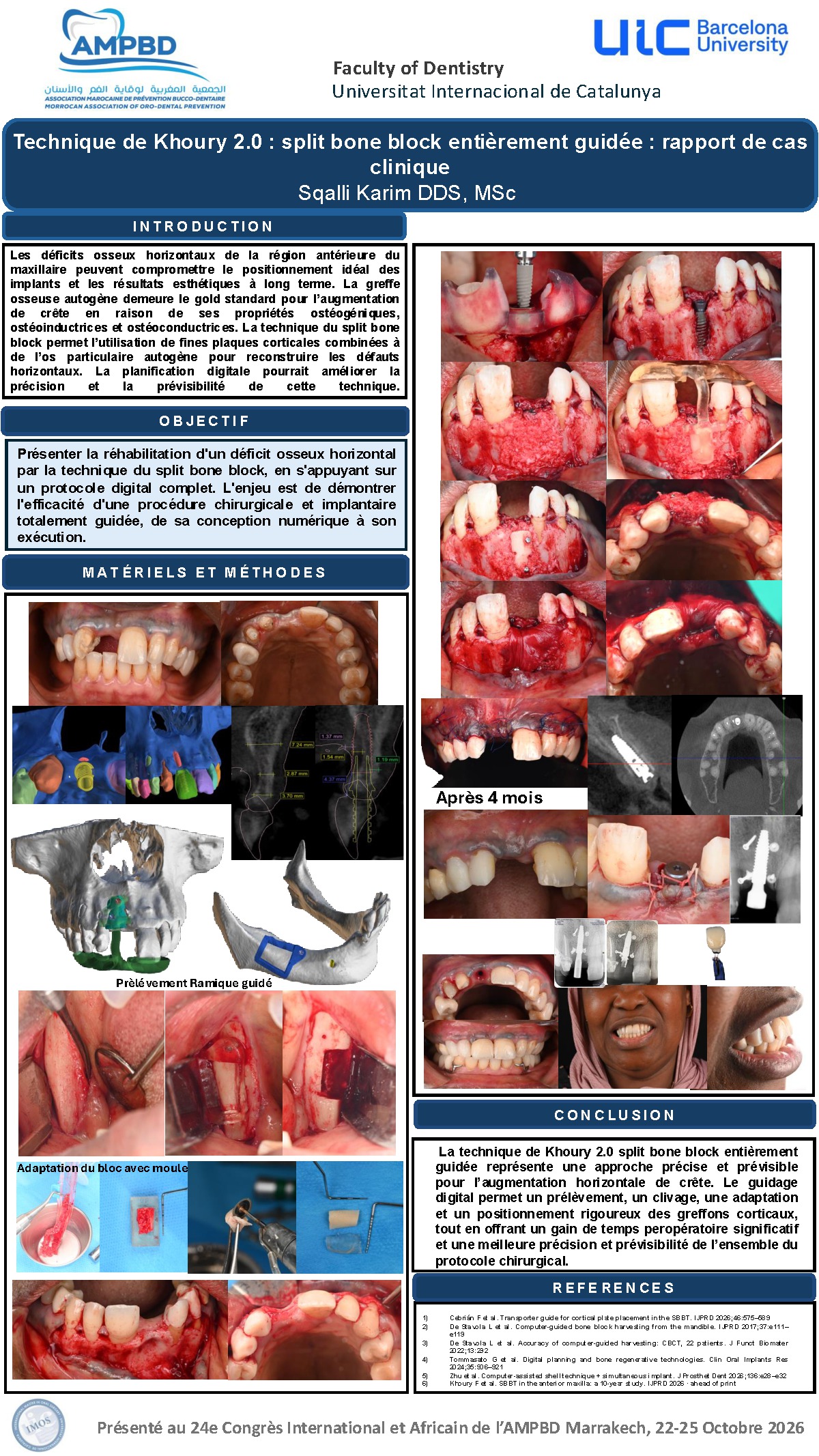 Technique de Khoury 2.0 : split bone block entièrement guidée. Rapport de cas clinique
