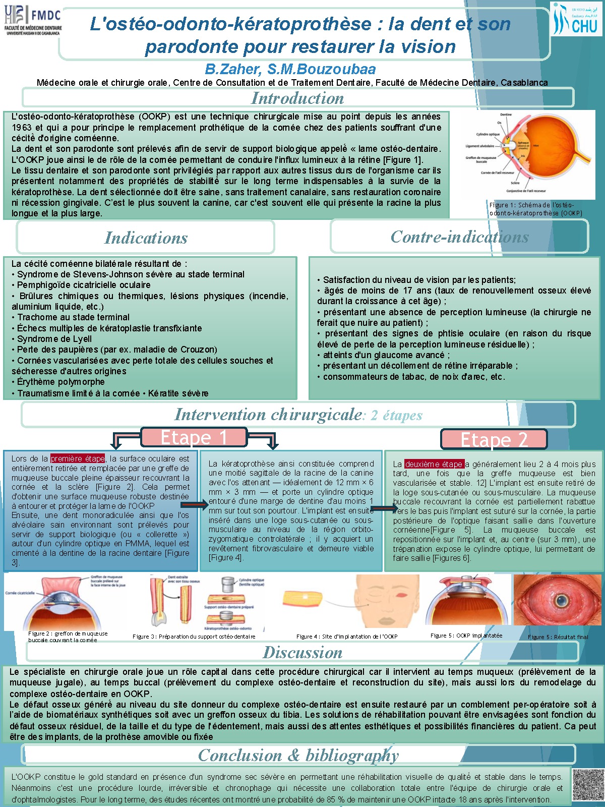 L'ostéo-odonto-kératoprothèse : la dent et son parodonte pour restaurer la vision